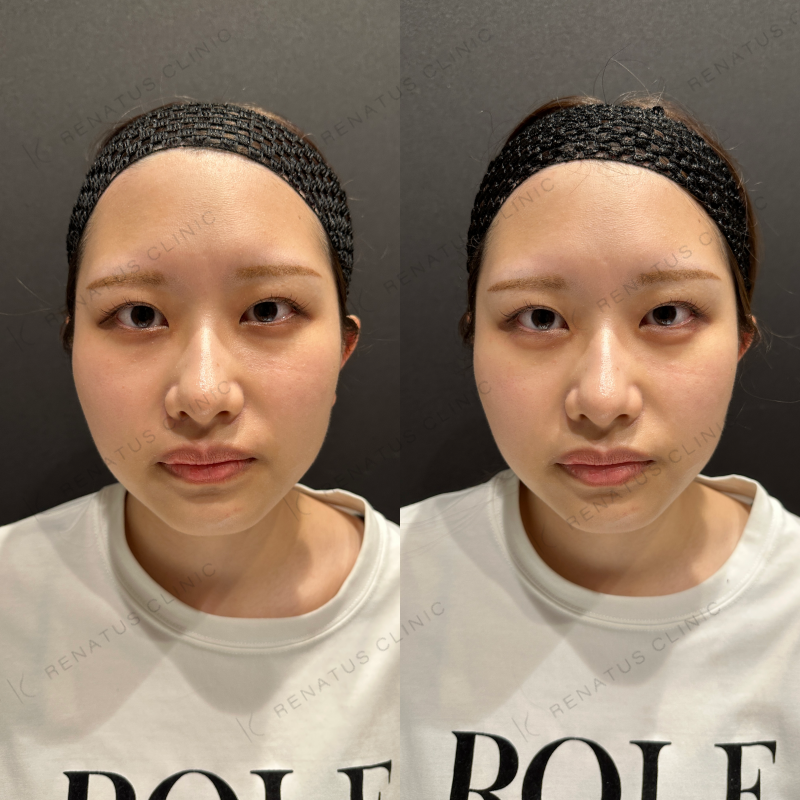 涙袋ヒアルロン酸ボルベラ症例写真