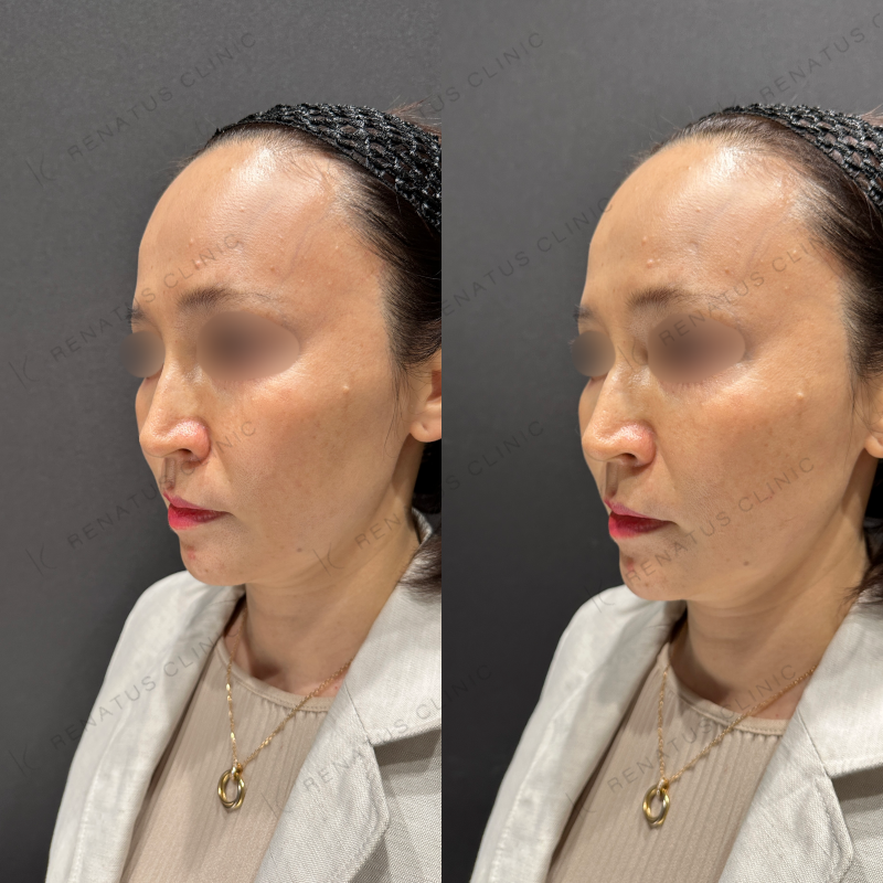 頬ヒアルロン酸ボリフト症例写真