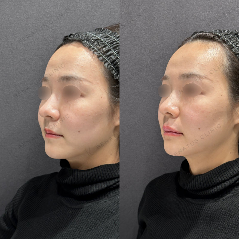 上唇・cカール・下唇ヒアルロン酸ボルベラ症例写真