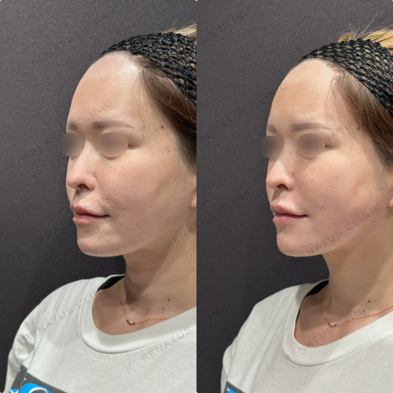 左頬コケヒアルロン酸ボリフト症例写真