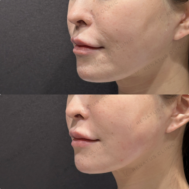 左頬コケヒアルロン酸ボリフト症例写真