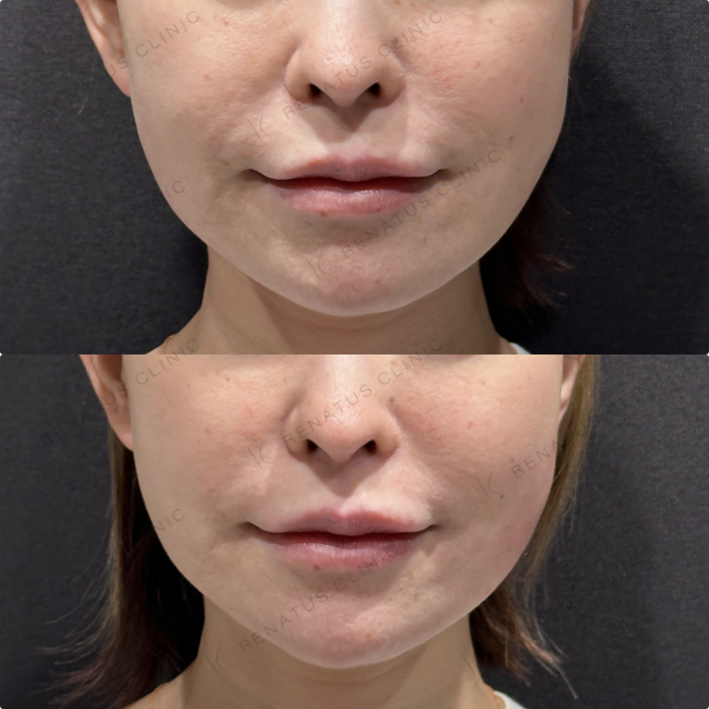 左頬コケヒアルロン酸ボリフト症例写真