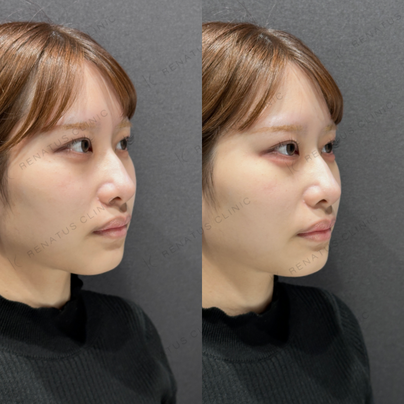 涙袋ヒアルロン酸ボルベラ症例写真