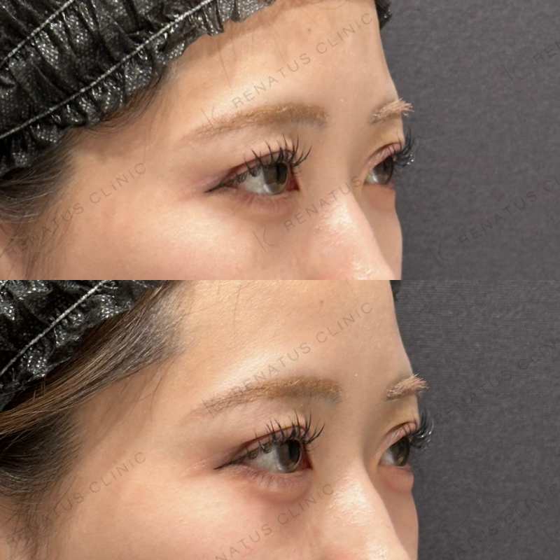 涙袋ヒアルロン酸ボルベラ症例写真