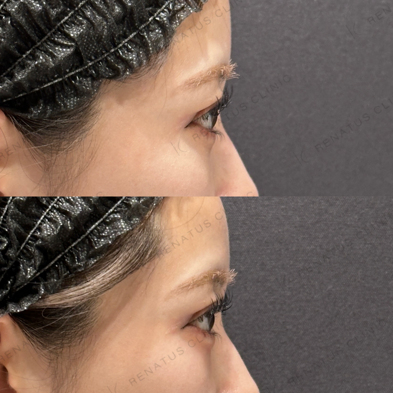 涙袋ヒアルロン酸ボルベラ症例写真