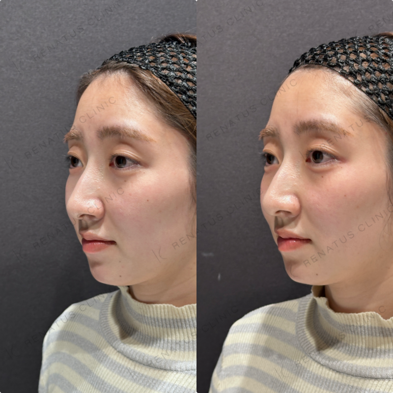 涙袋ヒアルロン酸ボルベラ症例写真