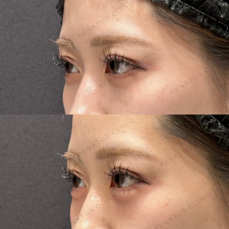 涙袋ヒアルロン酸ボルベラ症例写真