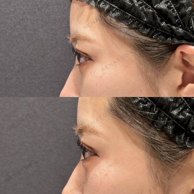 涙袋ヒアルロン酸ボルベラ症例写真