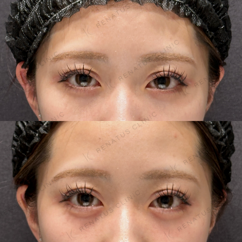 涙袋ヒアルロン酸ボルベラ症例写真