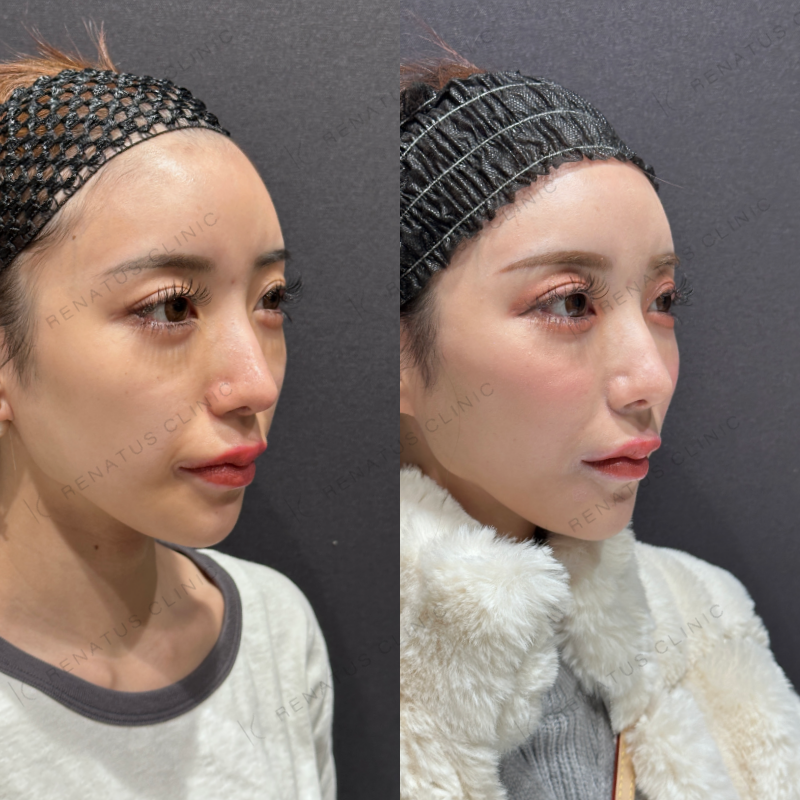頬ヒアルロン酸ボライト症例写真
