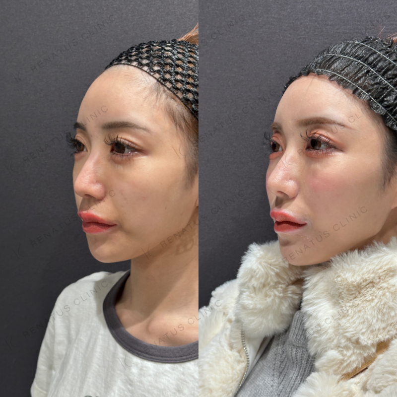 頬ヒアルロン酸ボライト症例写真