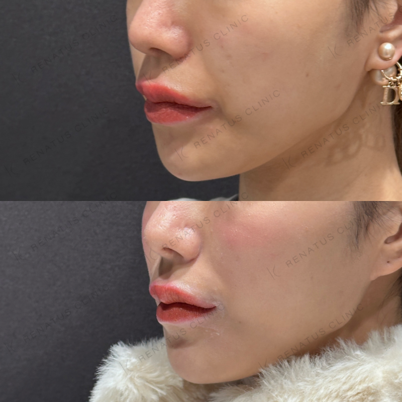 頬ヒアルロン酸ボライト症例写真