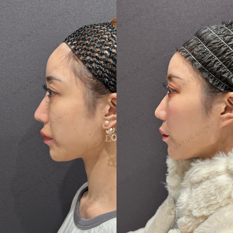 頬ヒアルロン酸ボライト症例写真