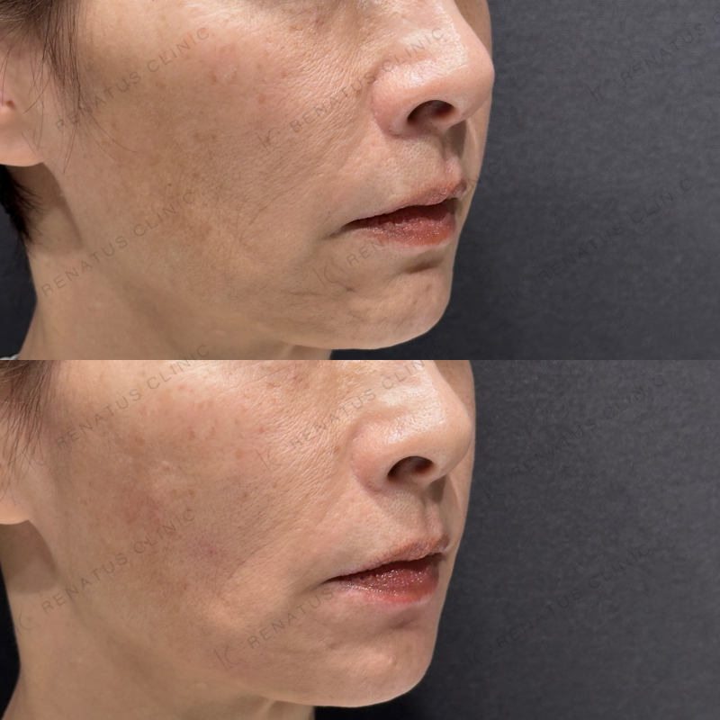 頬こけ・マリオネットヒアルロン酸ボリフト・ダイヤモンドフィール症例写真