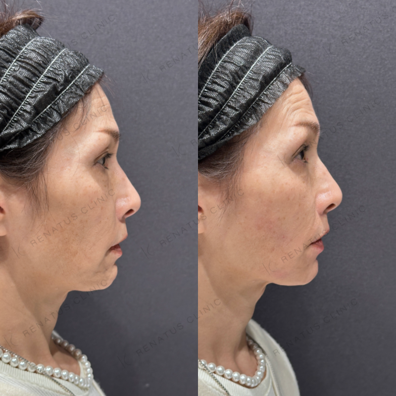 頬こけ・マリオネットヒアルロン酸ボリフト・ダイヤモンドフィール症例写真