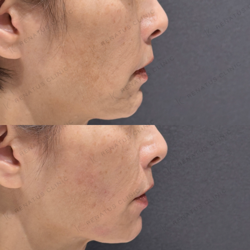 頬こけ・マリオネットヒアルロン酸ボリフト・ダイヤモンドフィール症例写真