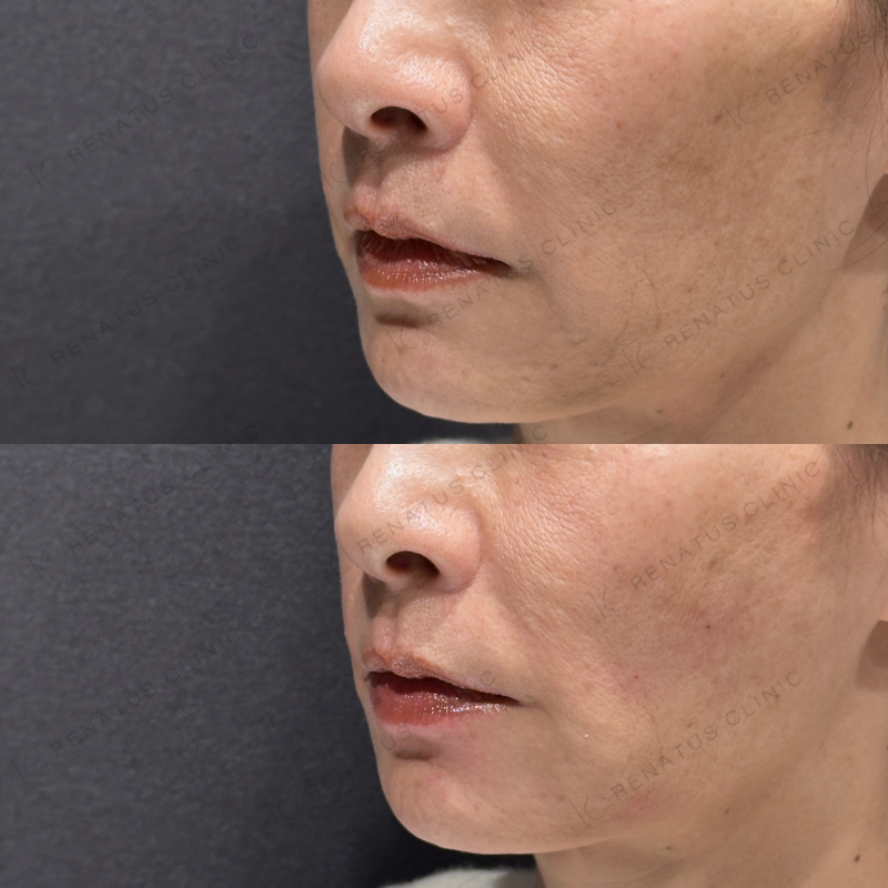 頬こけ・マリオネットヒアルロン酸ボリフト・ダイヤモンドフィール症例写真