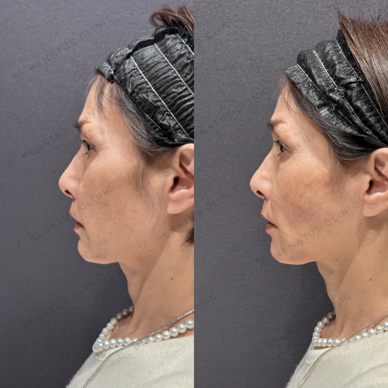 頬こけ・マリオネットヒアルロン酸ボリフト・ダイヤモンドフィール症例写真