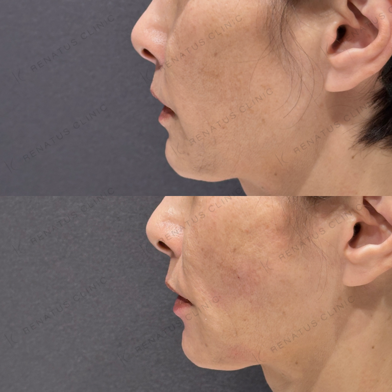 頬こけ・マリオネットヒアルロン酸ボリフト・ダイヤモンドフィール症例写真