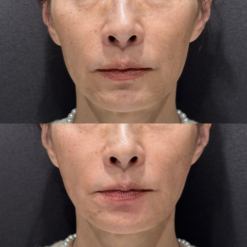 頬こけ・マリオネットヒアルロン酸ボリフト・ダイヤモンドフィール症例写真