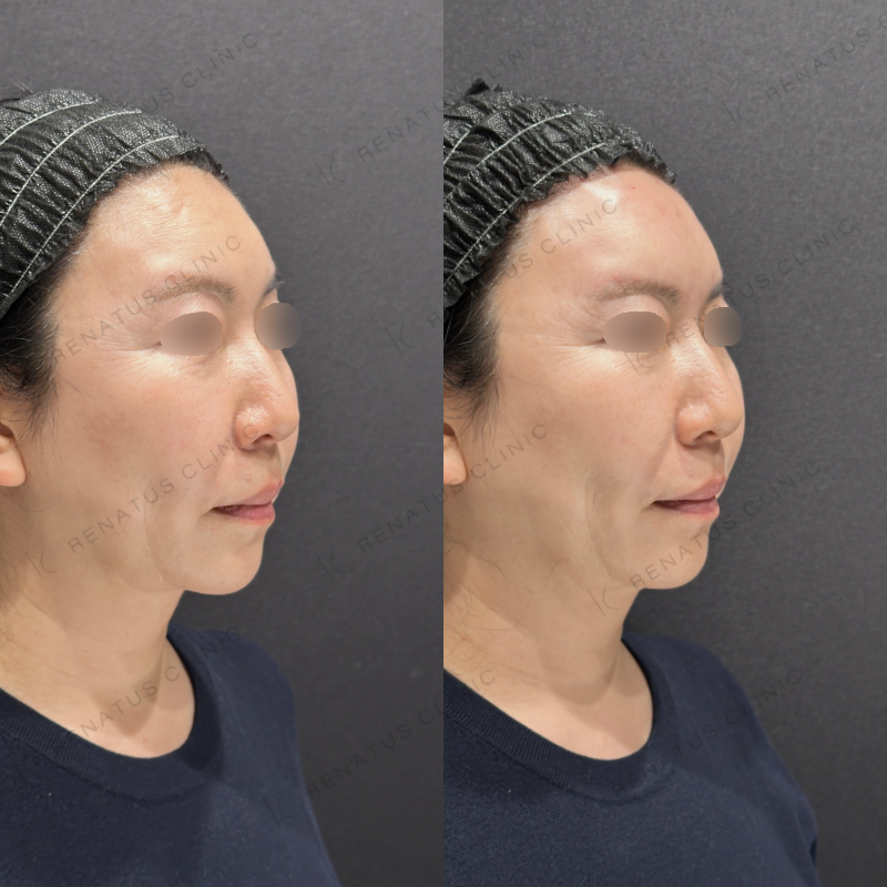 額ヒアルロン酸ボリューマ症例写真