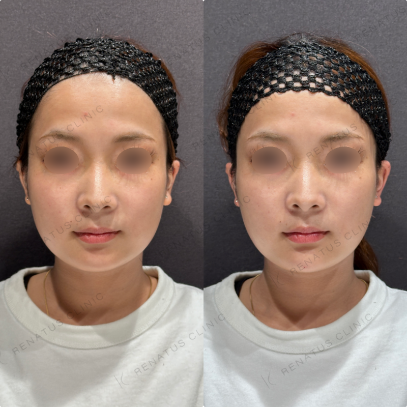顎ヒアルロン酸ボラックス症例写真