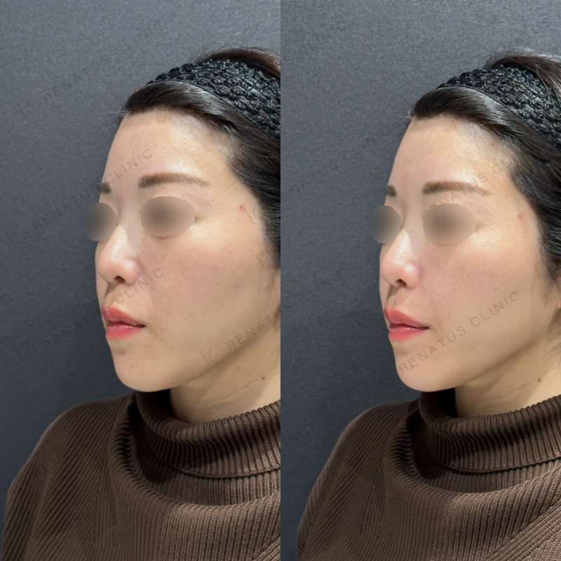 鼻翼基部ヒアルロン酸ボリフト症例写真