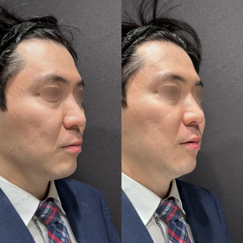 ほうれい線ヒアルロン酸ボリフト症例写真