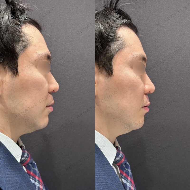 ほうれい線ヒアルロン酸ボリフト症例写真