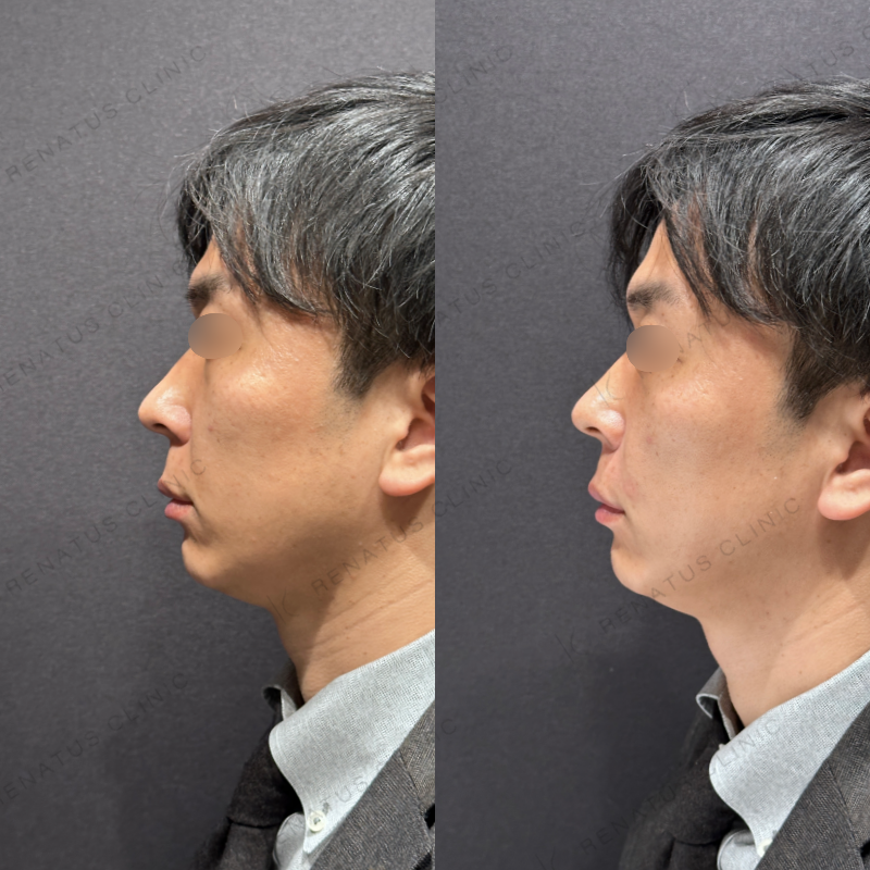 ほうれい線ヒアルロン酸ボリフト症例写真
