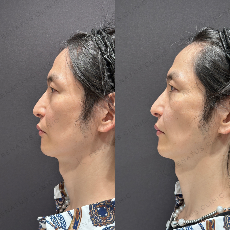ほうれい線ヒアルロン酸ボリフト症例写真