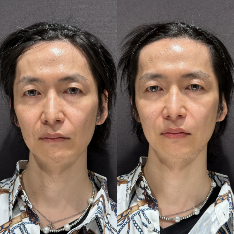 ほうれい線ヒアルロン酸ボリフト症例写真