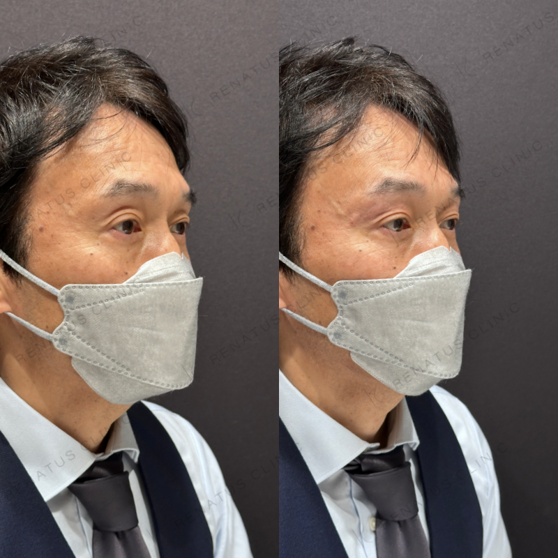 目の上ヒアルロン酸ボライト症例写真