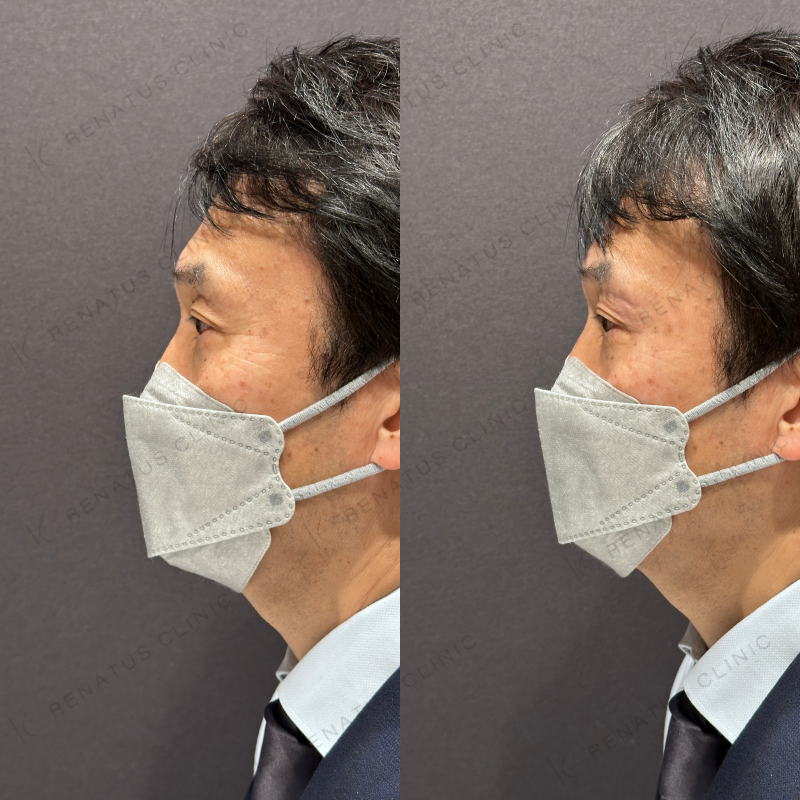 目の上ヒアルロン酸ボライト症例写真