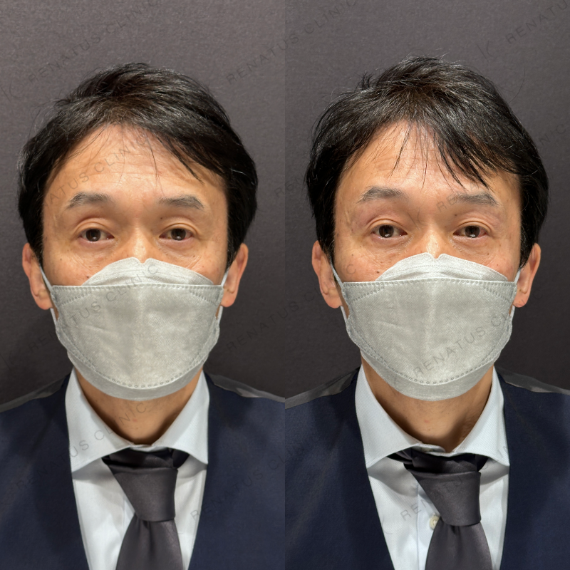 目の上ヒアルロン酸ボライト症例写真