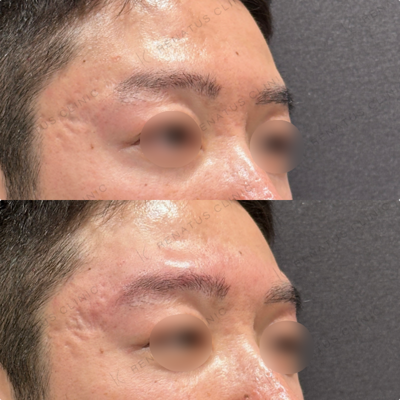 眉骨ヒアルロン酸ボラックス症例写真