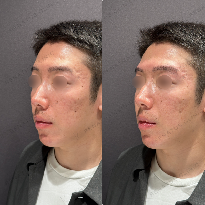眉骨ヒアルロン酸ボラックス症例写真