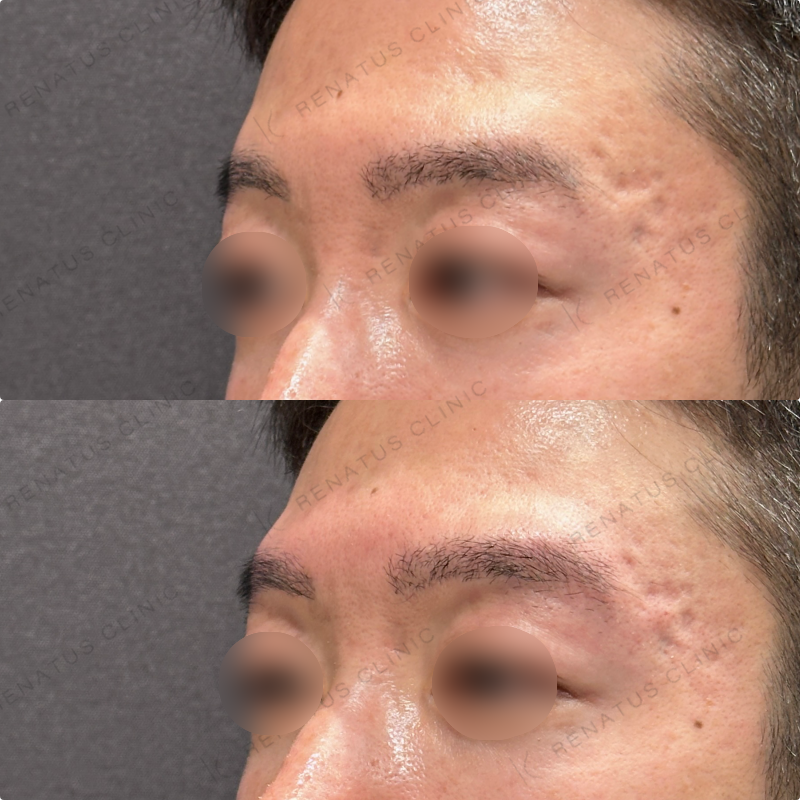 眉骨ヒアルロン酸ボラックス症例写真
