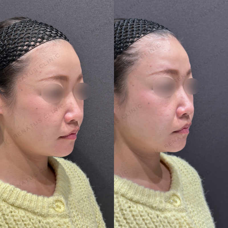 ほうれい線ヒアルロン酸ダイヤモンドフィール症例写真