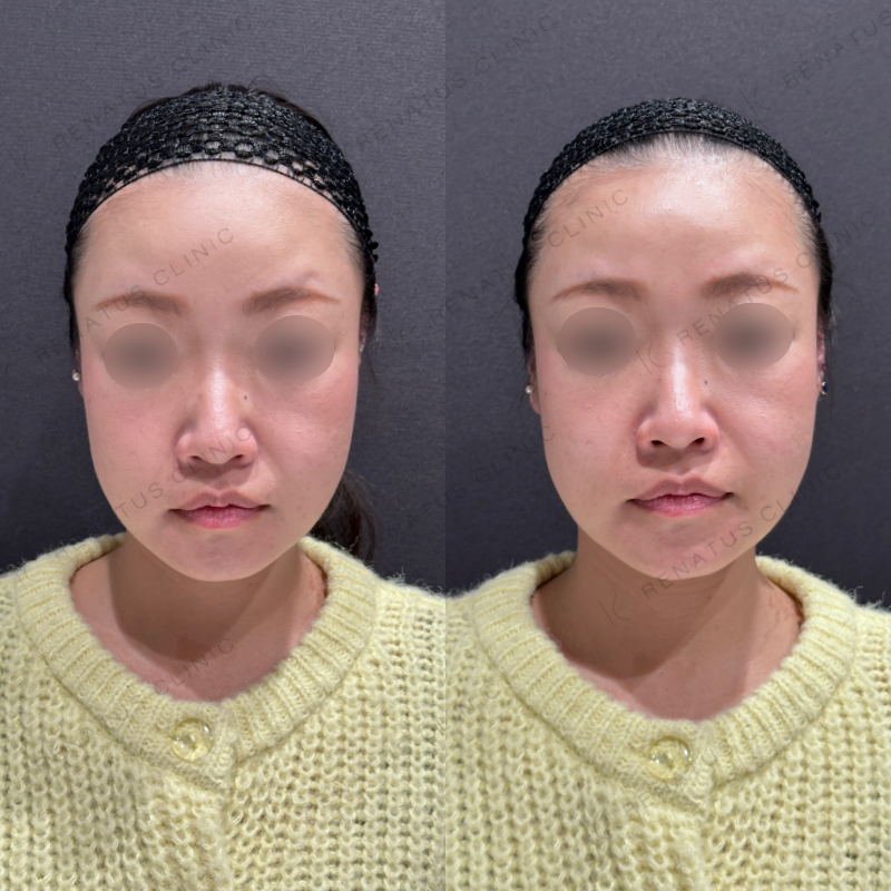 ほうれい線ヒアルロン酸ダイヤモンドフィール症例写真