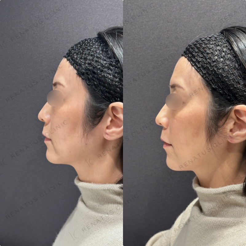 ほうれい線・マリオネットヒアルロン酸ボリフト症例写真