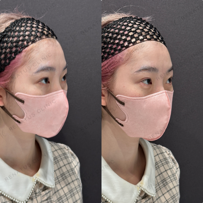 涙袋ヒアルロン酸ボルベラ症例写真