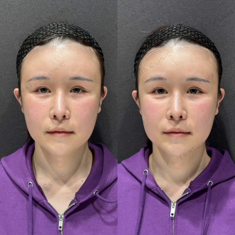 頬ヒアルロン酸ボリフト症例写真