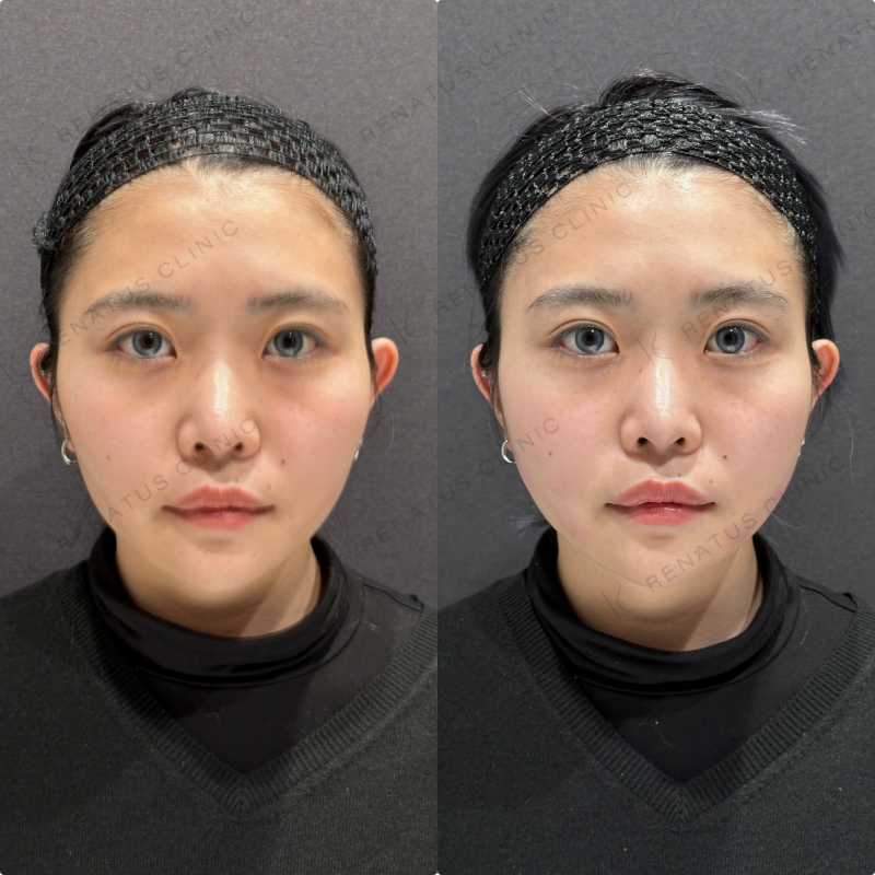 頬コケヒアルロン酸ボリフト症例写真