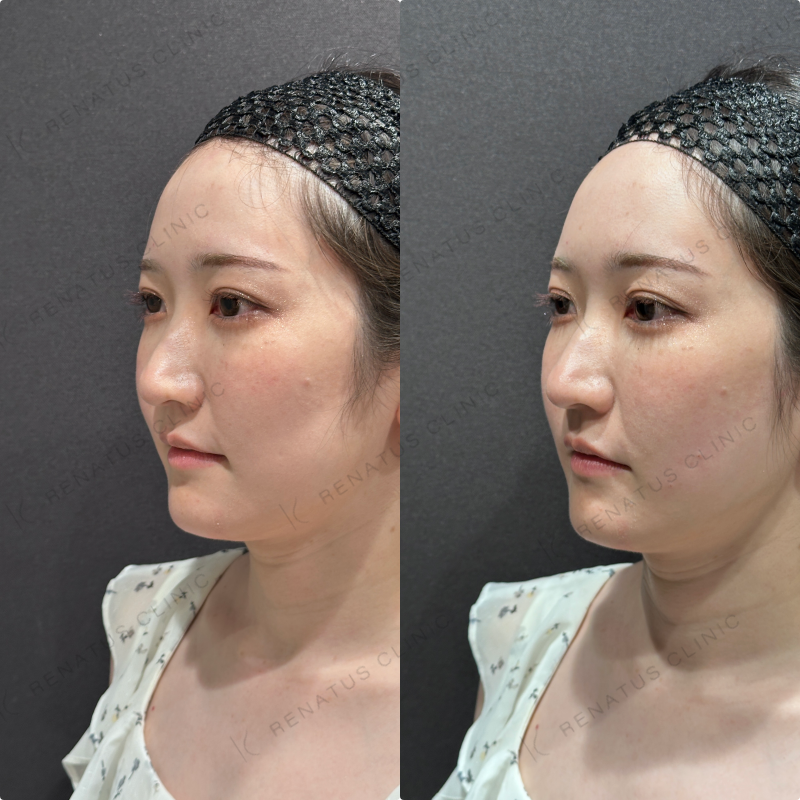 頬コケヒアルロン酸ボリフト症例写真