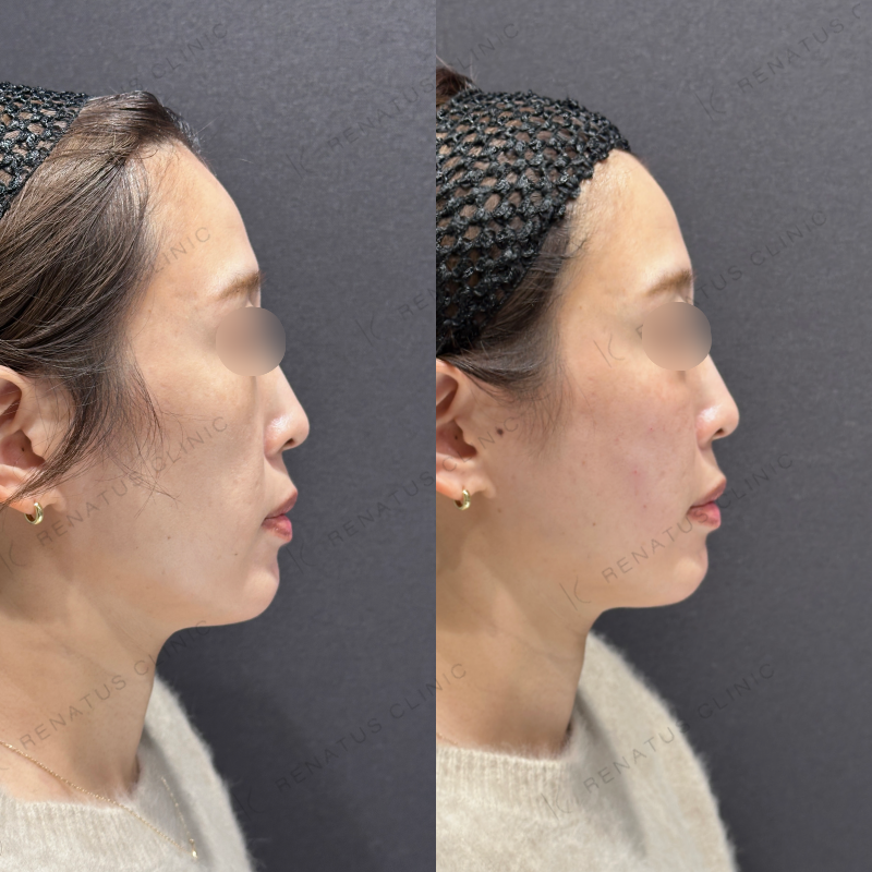 頬・頬こけ・ほうれい線ヒアルロン酸ボリフト症例写真