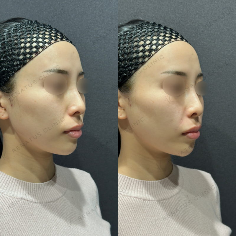 鼻翼基部ヒアルロン酸ボリフト症例写真