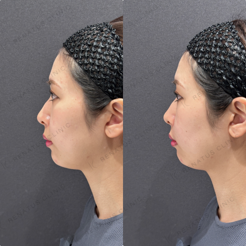 鼻翼基部ヒアルロン酸ボリフト症例写真