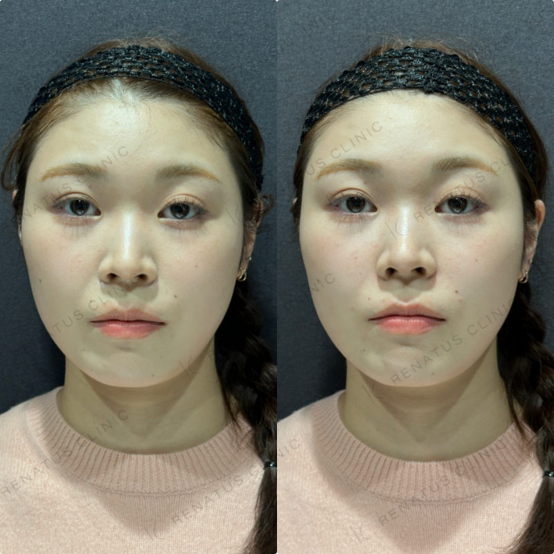 鼻翼基部ヒアルロン酸ボリフト症例写真