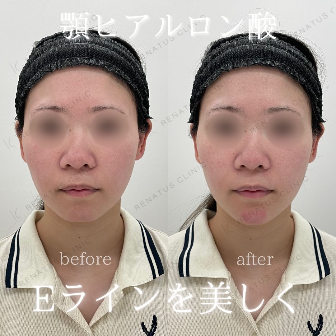 顎ヒアルロン酸ボラックス症例写真 顎ヒアルロン酸ボラックス症例写真